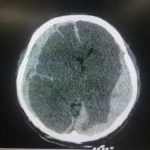 tbi