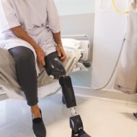 What Is it Called When You Lose a Limb in an Accident What Is it Called When You Lose a Limb in an Accident